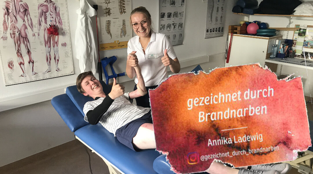 mutmachgeschichten-bei-brandverletzungen