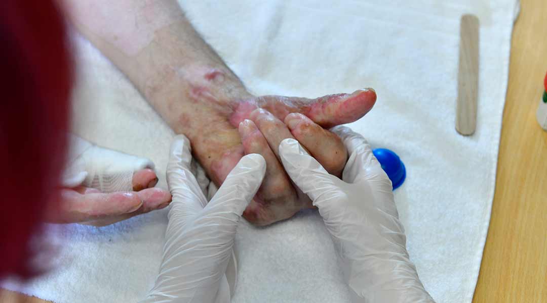 Schmerztherapie Narbenbehandlung an der Hand